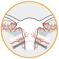 TissueSealAp2 TissueSealAp2