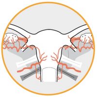 TissueSealAp2